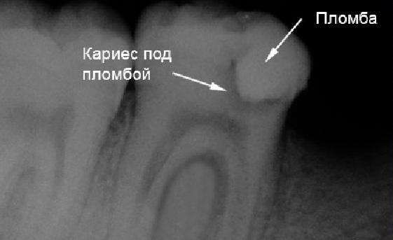 Рецидивы кариеса: как заметить и избежать